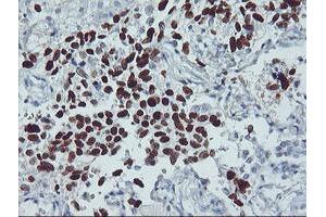 Immunohistochemistry (IHC) image for anti-Tumor Protein P53 (TP53) antibody (ABIN1499973) (p53 anticorps)