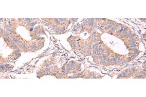 Immunohistochemistry of paraffin-embedded Human colorectal cancer tissue using ESM1 Polyclonal Antibody at dilution of 1:50(x200) (ESM1 anticorps)