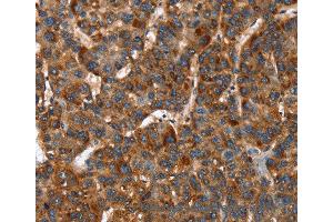 Immunohistochemistry of Human lung cancer using CACNB2 Polyclonal Antibody at dilution of 1:30 (CACNB2 anticorps)