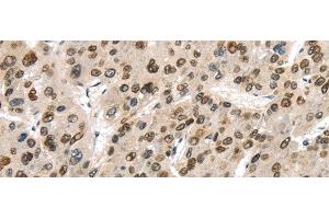 Immunohistochemistry of paraffin-embedded Human liver cancer using TUSC5 Polyclonal Antibody at dilution of 1/40 (TUSC5 anticorps)