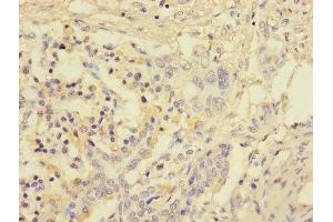 Immunohistochemistry of paraffin-embedded human pancreatic cancer using ABIN7153123 at dilution of 1:100 (FOSL2 anticorps  (AA 1-326))