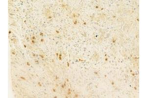 ABIN6261778 and ABIN6278766 at 1/100 staining human prostate carcinoma by IHC-P. (ZFPM2 anticorps  (C-Term))
