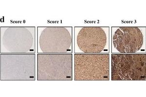 The expression of CXCR7 in metastatic melanoma cells and clinical samples.