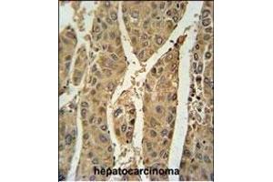 PRDX6 Antibody (Center) (ABIN650765 and ABIN2839536) immunohistochemistry analysis in formalin fixed and paraffin embedded human hepatocarcinoma followed by peroxidase conjugation of the secondary antibody and DAB staining.