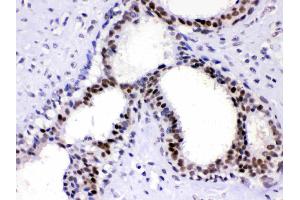 PC4 was detected in paraffin-embedded sections of human mammary cancer tissues using rabbit anti- PC4 Antigen Affinity purified polyclonal antibody (Catalog # ) at 1 µg/mL.
