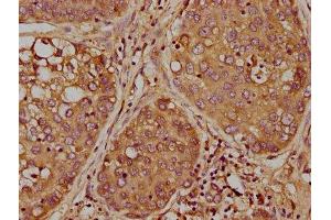 IHC image of ABIN7163597 diluted at 1:300 and staining in paraffin-embedded human liver cancer performed on a Leica BondTM system. (PAFAH2 anticorps  (AA 1-206))