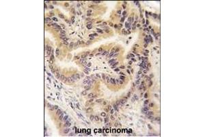 Formalin-fixed and paraffin-embedded human lung carcinoma tissue reacted with RAF1 Antibody   , which was peroxidase-conjugated to the secondary antibody, followed by DAB staining. (RAF1 anticorps  (AA 211-240))