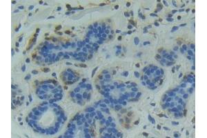 DAB staining on IHC-P; Samples: Human Breast cancer Tissue