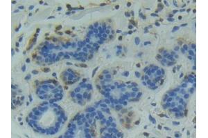 DAB staining on IHC-P; Samples: Human Breast cancer Tissue (GSK3 alpha anticorps  (AA 115-409))