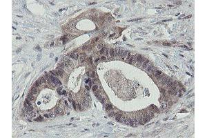 Immunohistochemical staining of paraffin-embedded Adenocarcinoma of Human colon tissue using anti-OTUB1 mouse monoclonal antibody. (OTUB1 anticorps)