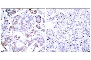 Immunohistochemical analysis of paraffin-embedded human breast carcinoma tissue, using NF-κB p65 (Ab-254) antibody (E021010). (NF-kB p65 anticorps)