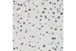 Immunohistochemistry of paraffin-embedded human liver damage using U2SURP antibody (ABIN6132839, ABIN6149759, ABIN6149760 and ABIN6220240) at dilution of 1:100 (40x lens). (SR140 anticorps  (AA 705-1029))