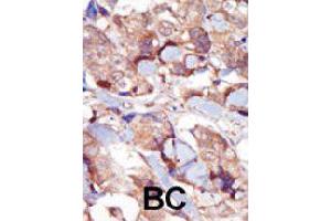 Immunohistochemistry (Formalin/PFA-fixed paraffin-embedded sections) of human breast carcinoma with MYLK3 polyclonal antibody , followed by peroxidase-conjugated secondary antibody and DAB staining. (MYLK3 anticorps  (AA 40-69))
