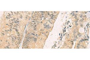 Immunohistochemistry of paraffin-embedded Human colorectal cancer tissue using THG1L Polyclonal Antibody at dilution of 1:70(x200) (THG1L anticorps)