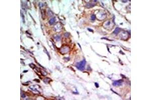 IHC analysis of FFPE human breast carcinoma tissue stained with the ERK5 antibody (MAPK7 anticorps  (AA 776-805))