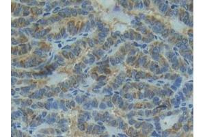 Detection of IL1R1 in Human Thyroid cancer Tissue using Polyclonal Antibody to Interleukin 1 Receptor Type I (IL1R1)