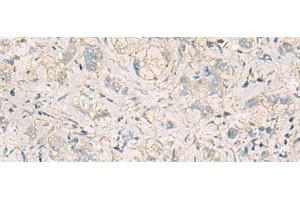 Immunohistochemistry of paraffin-embedded Human liver cancer tissue using WDR37 Polyclonal Antibody at dilution of 1:50(x200) (WDR37 anticorps)