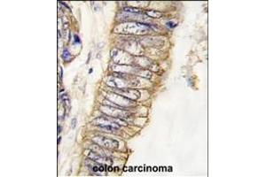 Formalin-fixed and paraffin-embedded human colon carcinoma tissue reacted with MET/HGFR Antibody (ABIN387741 and ABIN2837999) , which was peroxidase-conjugated to the secondary antibody, followed by DAB staining.