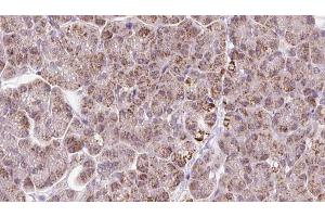 ABIN6273247 at 1/100 staining Human pancreas cancer tissue by IHC-P.