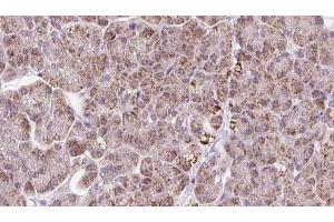 ABIN6273247 at 1/100 staining Human pancreas cancer tissue by IHC-P. (ARHGEF25/GEFT anticorps  (Internal Region))