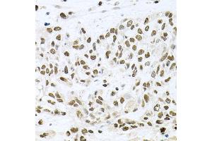 Immunohistochemistry of paraffin-embedded human lung cancer using BCCIP antibody.
