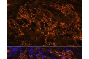 Immunofluorescence analysis of Human kidney cancer using SLC7A9 Polyclonal Antibody at dilution of 1:100.