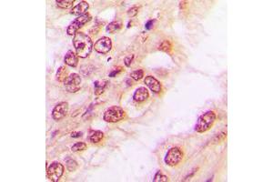 Immunohistochemical analysis of PAWR staining in human breast cancer formalin fixed paraffin embedded tissue section.