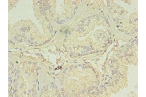 Immunohistochemistry of paraffin-embedded human prostate cancer using ABIN7151288 at dilution of 1:100