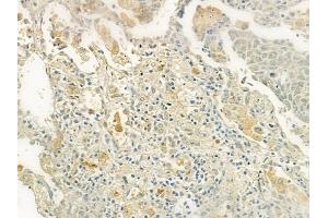 ABIN6261444 and ABIN6277566 at 1/100 staining human lung squamous cell carcinoma by IHC-P.