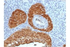 Formalin-fixed, paraffin-embedded human cervix stained with P16INK4a Recombinant Mouse Monoclonal Antibody (rCDKN2A/4845). (Recombinant CDKN2A anticorps)