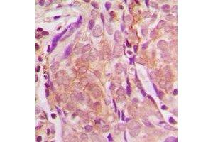 Immunohistochemical analysis of ZNF397 staining in human breast cancer formalin fixed paraffin embedded tissue section.