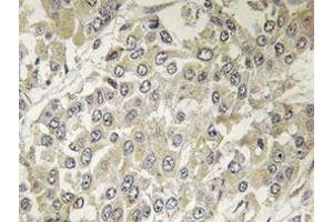Immunohistochemistry analyzes of p70 S6K antibody in paraffin-embedded human breast carcinoma tissue. (RPS6KB1 anticorps)