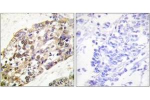 Immunohistochemistry analysis of paraffin-embedded human breast carcinoma tissue, using Histone H3 (Ab-28) Antibody. (Histone 3 anticorps  (AA 13-62))