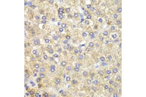 Immunohistochemistry of paraffin-embedded human liver cancer using HADH antibody at dilution of 1:100 (400x lens). (HADH anticorps)