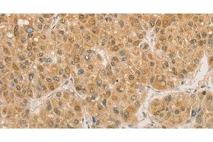 Immunohistochemistry of paraffin-embedded Human liver cancer using PGK2 Polyclonal Antibody at dilution of 1:50