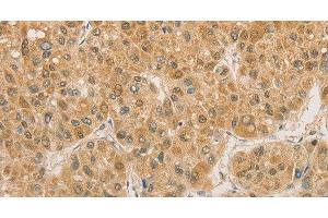 Immunohistochemistry of paraffin-embedded Human liver cancer using PGK2 Polyclonal Antibody at dilution of 1:50 (PGK2 anticorps)