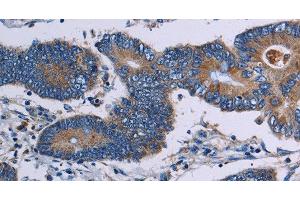 Immunohistochemistry of paraffin-embedded Human colon cancer tissue using ITK Polyclonal Antibody at dilution 1:50 (ITK anticorps)