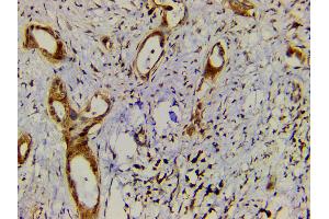 ABIN6277691 at 1/200 staining human cholangiocarcinoma tissue sections by IHC-P. (Ephrin B2 anticorps  (C-Term))