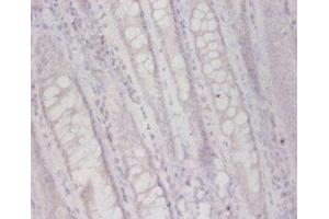 Immunohistochemistry of paraffin-embedded human colon cancer using ABIN7163507 at dilution of 1:50 (FUCA2 anticorps  (AA 29-465))
