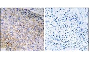 Immunohistochemistry analysis of paraffin-embedded human breast carcinoma tissue, using NOX3 Antibody. (NOX3 anticorps  (AA 287-336))