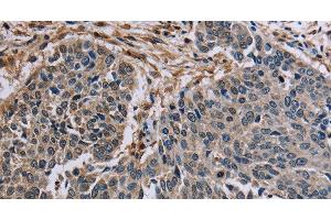 Immunohistochemistry of paraffin-embedded Human lung cancer tissue using PNPT1 Polyclonal Antibody at dilution 1:40