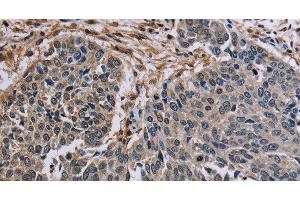 Immunohistochemistry of paraffin-embedded Human lung cancer tissue using PNPT1 Polyclonal Antibody at dilution 1:40 (PNPT1 anticorps)