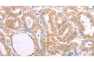 Immunohistochemistry of paraffin-embedded Human thyroid cancer tissue using pVHL Polyclonal Antibody at dilution 1:40 (VHL anticorps)