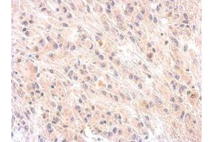 IHC-P Image Immunohistochemical analysis of paraffin-embedded U373 xenograft, using Factor H, antibody at 1:200 dilution. (Complement Factor H anticorps)
