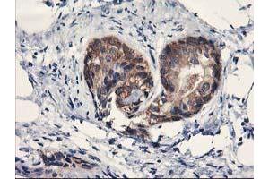 Immunohistochemical staining of paraffin-embedded Adenocarcinoma of Human breast tissue using anti-PDE4B mouse monoclonal antibody. (PDE4B anticorps)