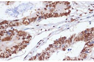 Immunohistochemistry of paraffin-embedded Human colon carcinoma using PELP1 Polyclonal Antibody at dilution of 1:100 (40x lens). (PELP1 anticorps)