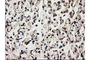 Immunohistochemical staining of paraffin-embedded Adenocarcinoma of Human colon tissue using anti-ACOT12 mouse monoclonal antibody. (ACOT12 anticorps)