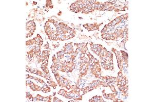 Immunohistochemistry of paraffin-embedded Human thyroid cancer using FRMD6 antibody (ABIN6132194, ABIN6140773, ABIN6140774 and ABIN6225347) at dilution of 1:100 (40x lens). (FRMD6 anticorps  (AA 405-614))