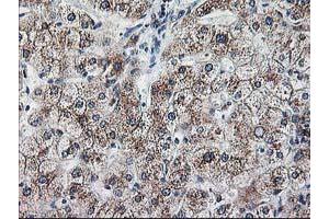 Immunohistochemical staining of paraffin-embedded Human liver tissue using anti-RPN1 mouse monoclonal antibody. (RPN1 anticorps)
