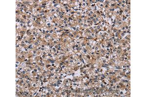 Immunohistochemistry of Human prostate cancer using IPO4 Polyclonal Antibody at dilution of 1:50 (Importin 4 anticorps)
